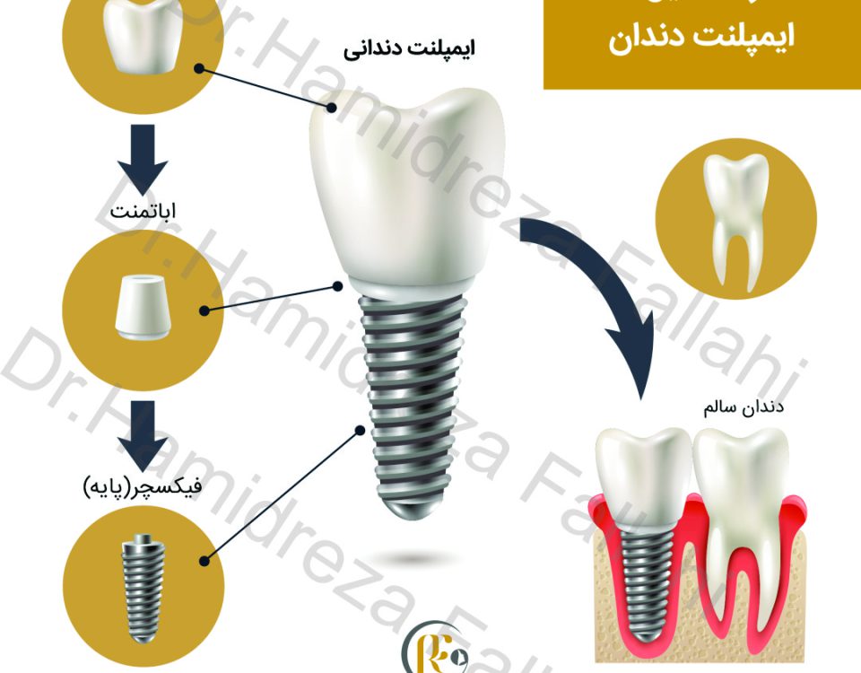 اجزا ایمپلنت دندان